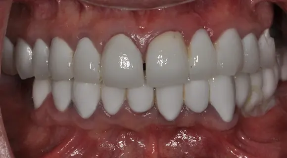 Case 1, before: a gap between the front teeth.