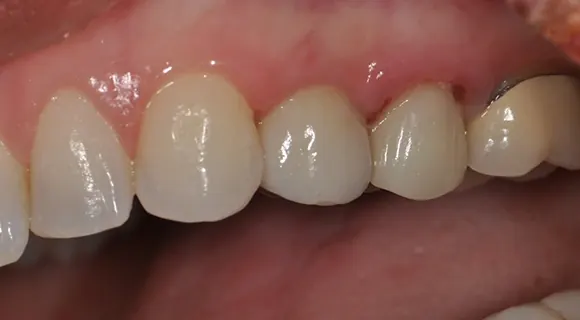 Case 2, after treatment at Ponte Vedra Family Dentistry.