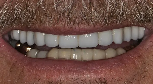 Case 4, after treatment at Ponte Vedra Family Dentistry.